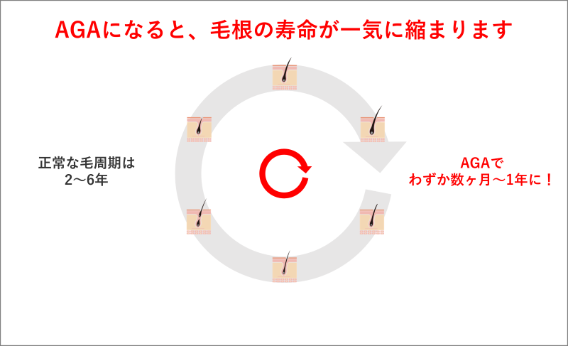 AGAになると毛根の寿命が一気に縮まります