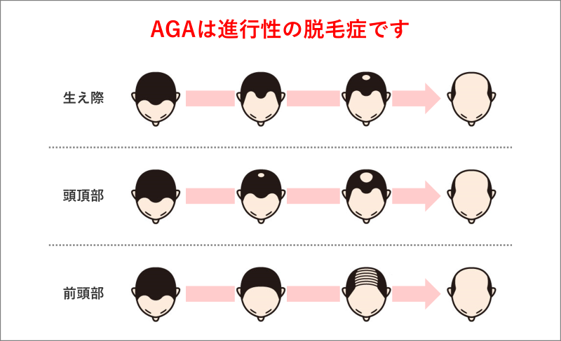 AGAは進行性の脱毛症